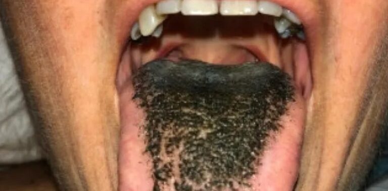 Descubren nueva enfermedad denominada “síndrome de lengua peluda negra»