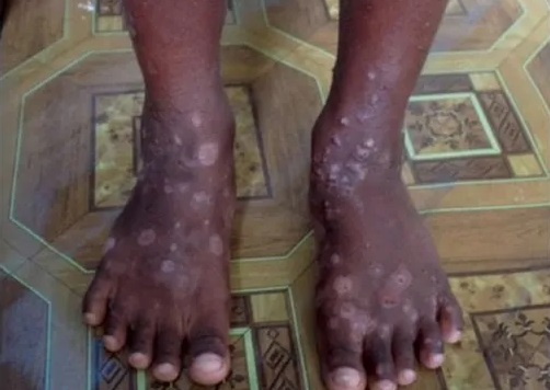 Piden a la población de RD no alarmarse ante infección cutánea en Haití