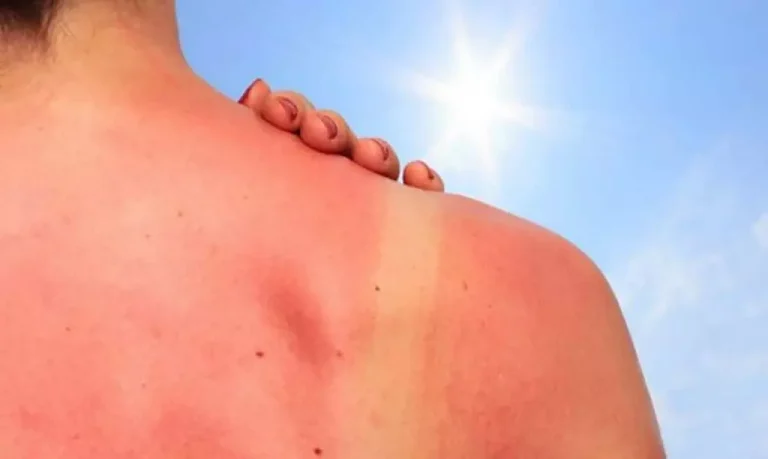 Dermatología registra 521 casos de cáncer de piel en 2023