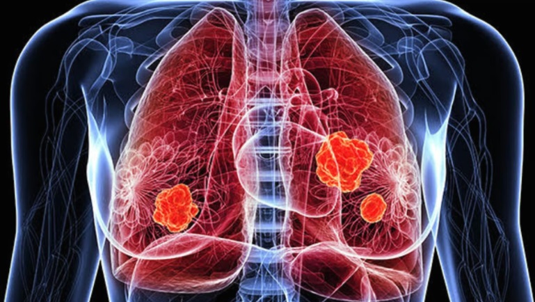 OMS alerta sobre medicamento falsificado para tratar el cáncer de pulmón