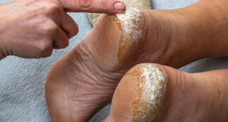 Varias formas para combatir las grietas en los talones