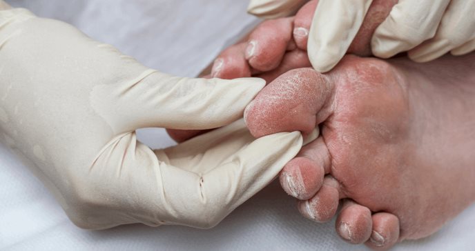 Pie diabético: una complicación frecuente que puede prevenirse con cinco recomendaciones y hábitos simples