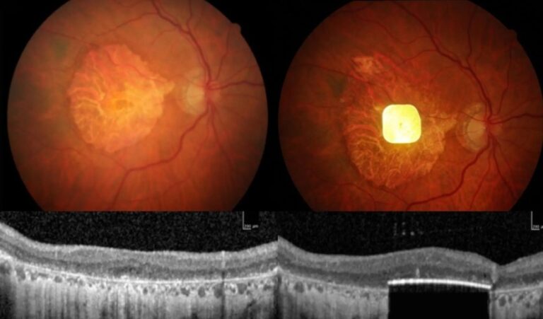 Una prótesis ocular permite leer a personas con ceguera irreversible