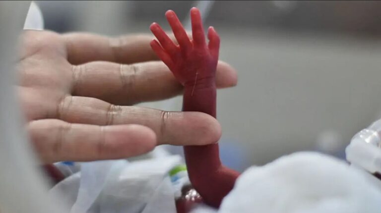 Demuestran los beneficios de transfundir sangre de cordón umbilical a prematuros extremos